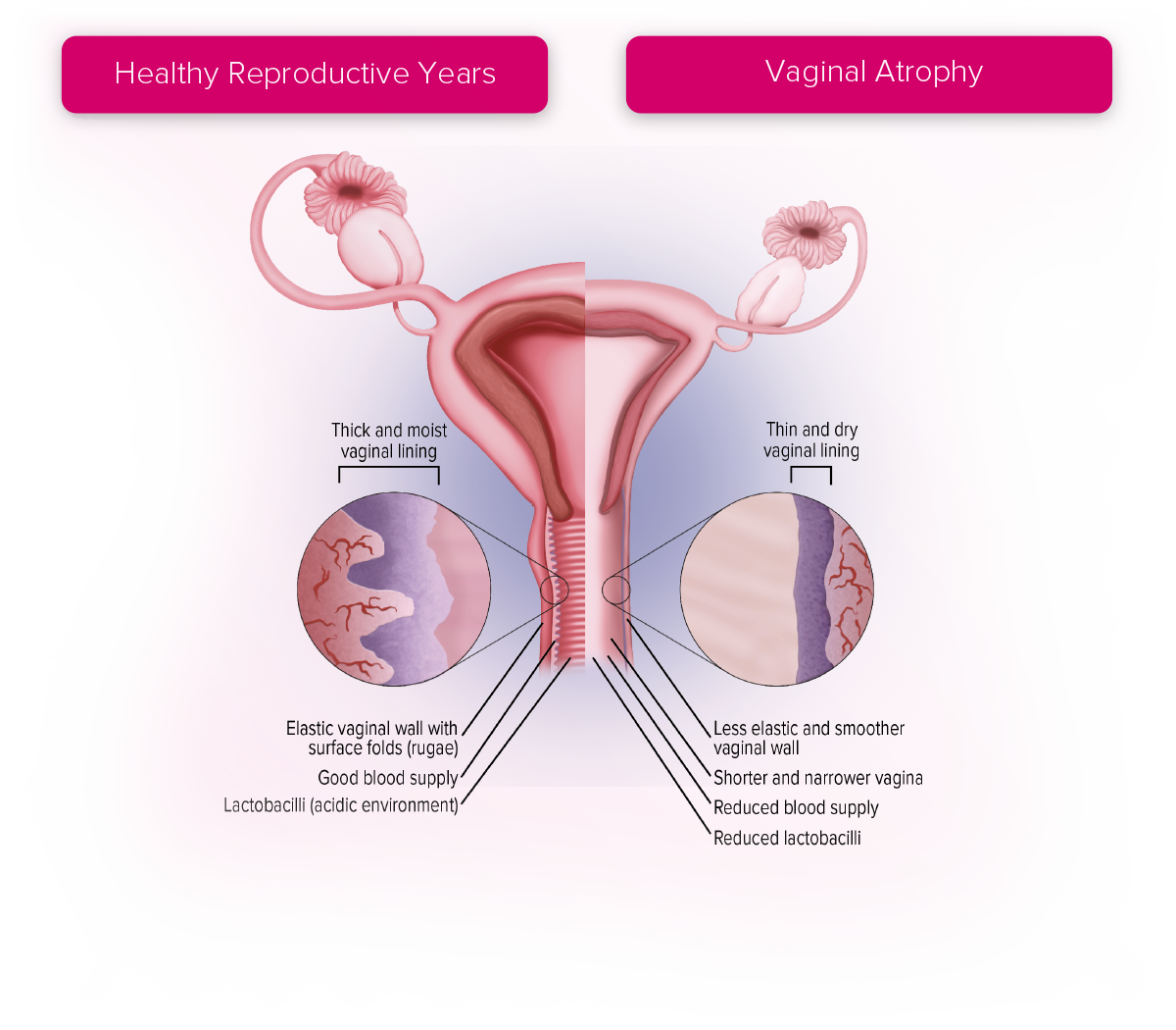 Vaginal Atrophy Ftm