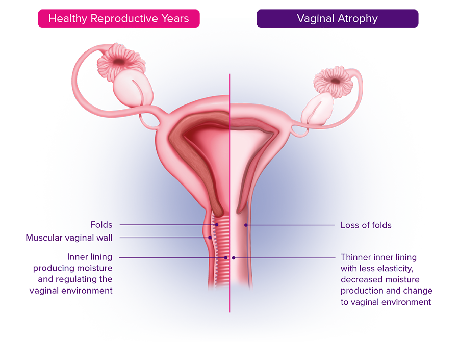 Menopause Vaginal Discomfort Ovesse 1mg g Vaginal Cream Estriol