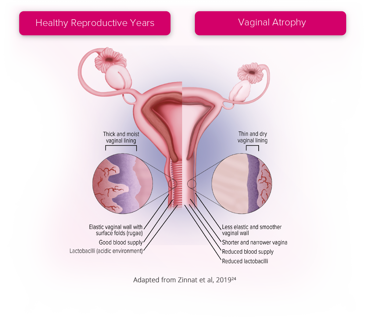 Ovesse Vaginal Atrophy Diagram Ovesse Vaginal Atrophy Diagram